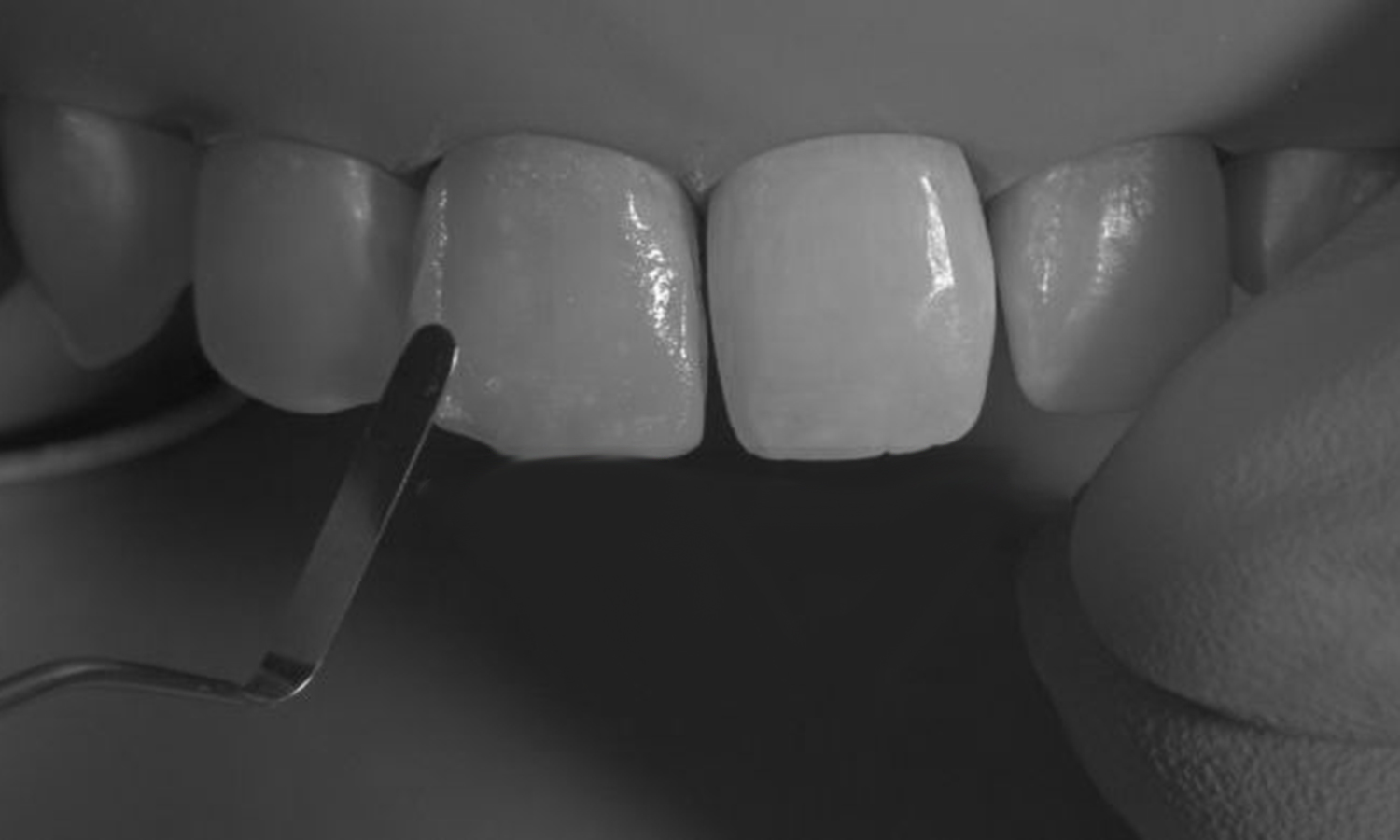 lente de contato dental em resina dente anterior da frente