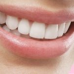 Lente de contato dental em resina: indicações, prós e contras.