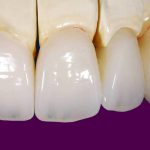 Prótese dentária em zircônia: indicações, prós e contras.