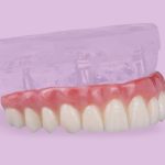 Prótese protocolo: veja quantos implantes dentários são necessários.