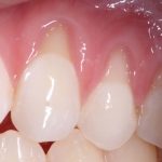 Gengiva retraída em dente com prótese dentária: recuperando a estética.