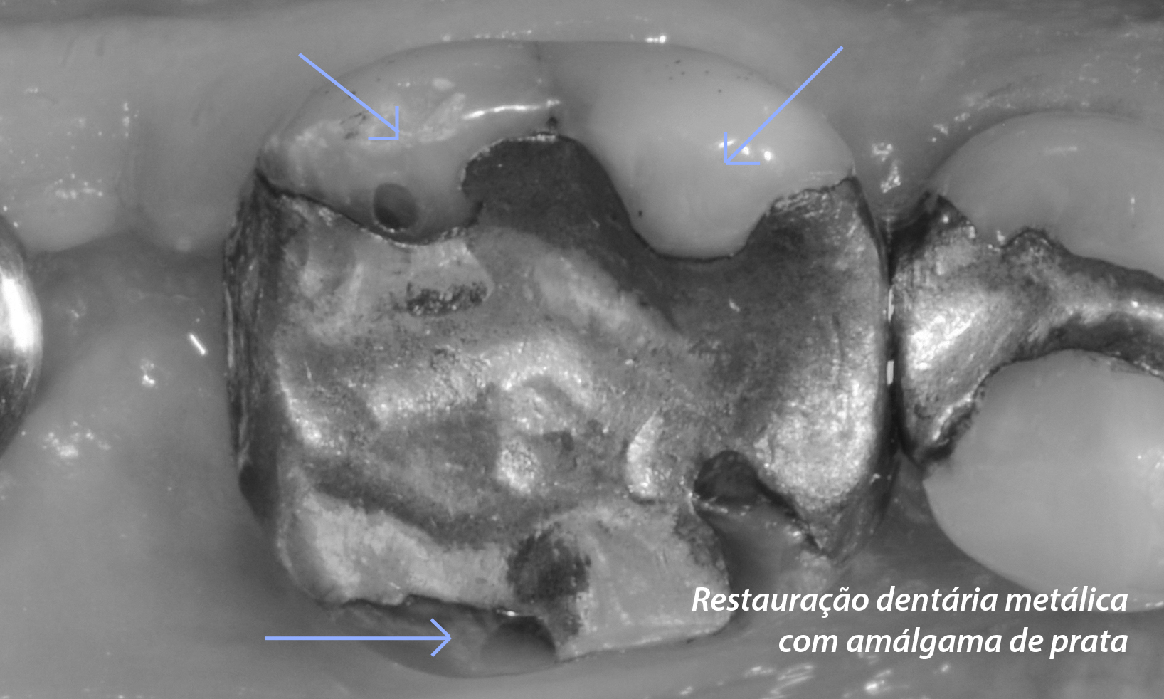 restauração dental com metal amálgama