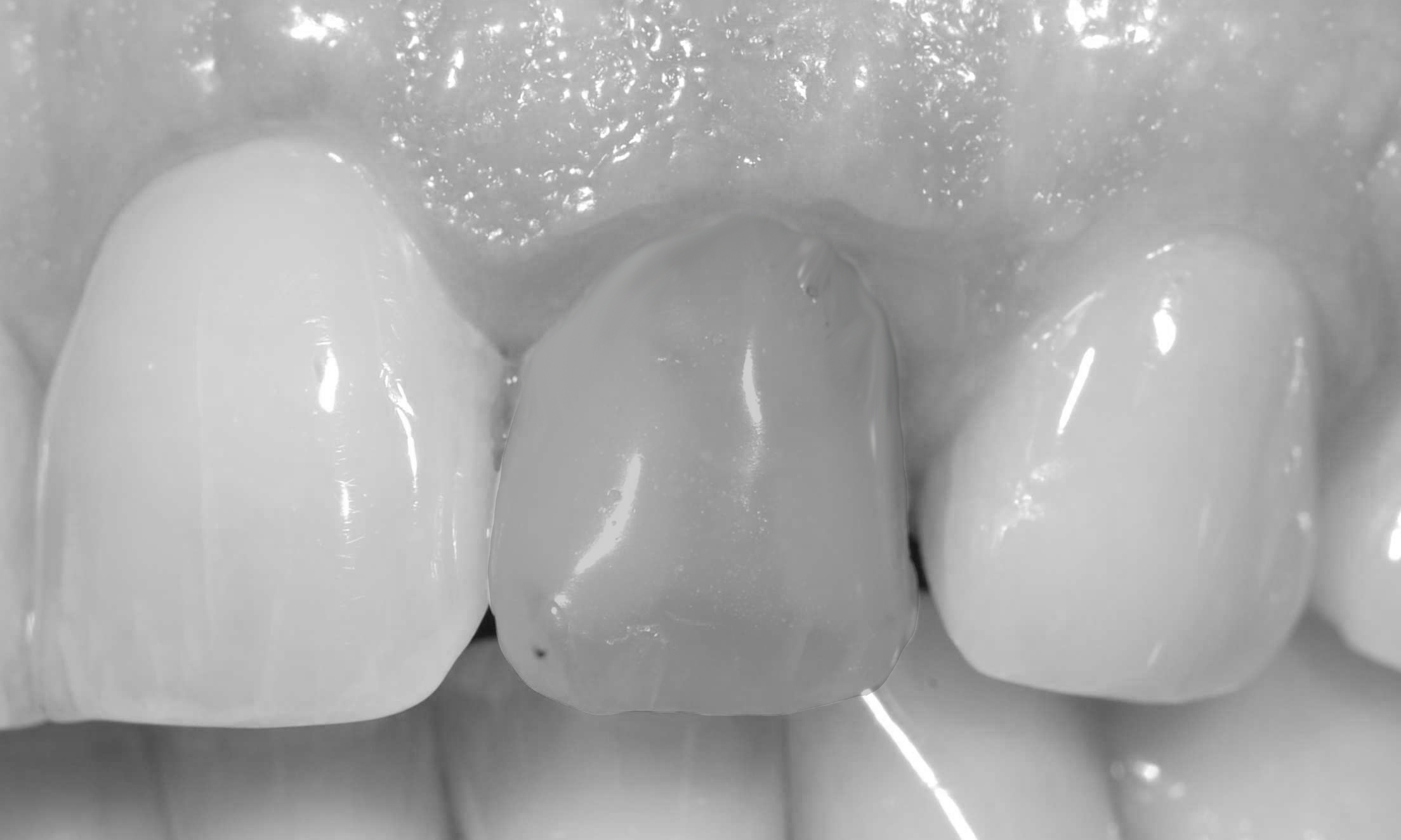 dente escurecido fratura de dente