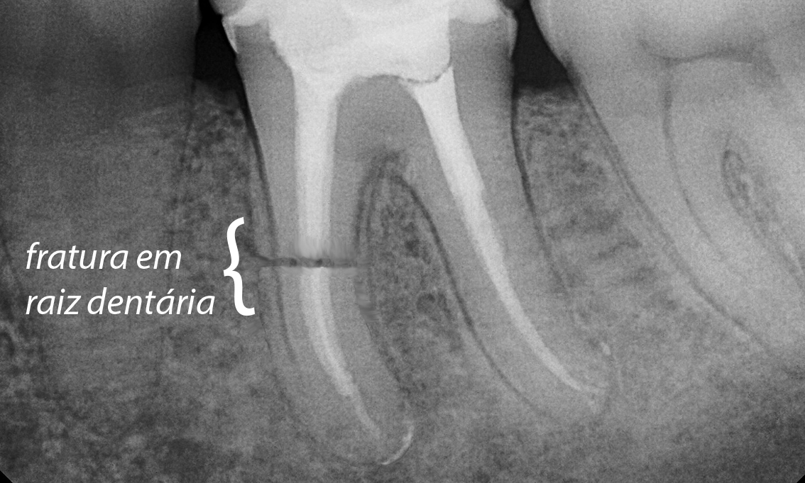 fratura em raiz dentária radiografia cópia