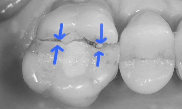 restauração em resina dente quebrado fratura