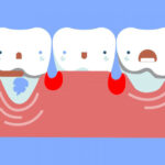 Retração gengival por periodontite: recuperar gengivas é difícil e restrito.