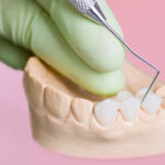 Prótese dentária fixa: o que é, os tipos e o melhor material explicados.