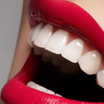 Lente de contato dental: especialista explica como é o tratamento.