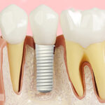 Gengiva retraída em implante dentário: causas e recuperação estética.