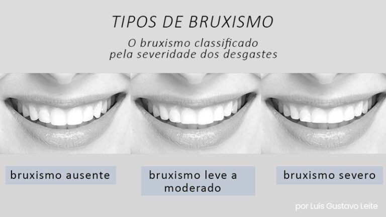 Quais são os sinais de bruxismo?