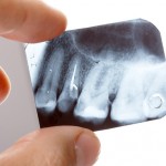 dente qeubrado