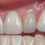 dente escurecido por tratamento de canal
