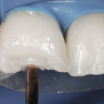 restauração-com-resina-de-dentes-desgastados-por-bruxismo capa