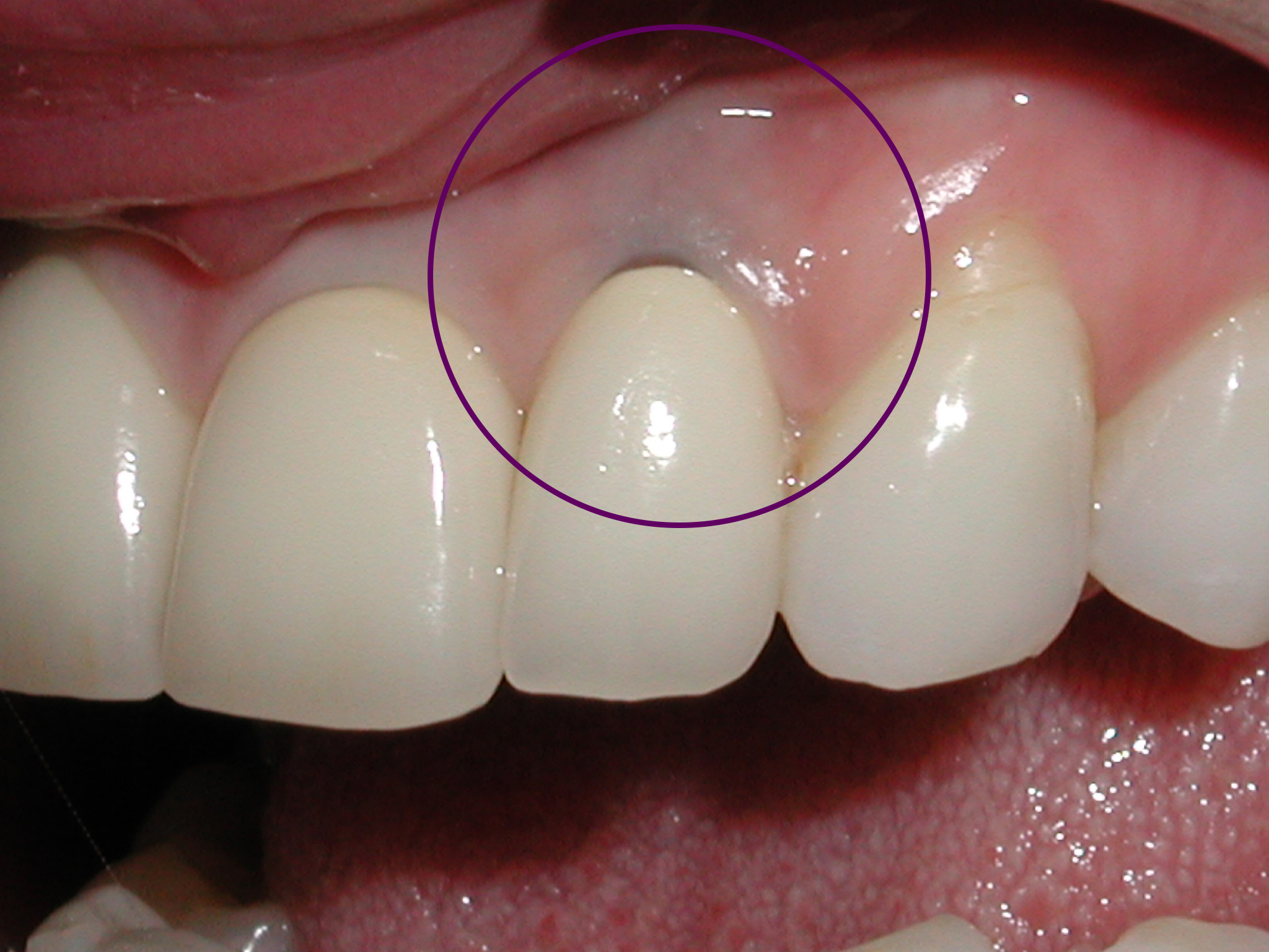 Prótese dentária fixa em porcelana problemas metaloceramica