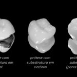 prótese-dentária-em-porcelana-tipo
