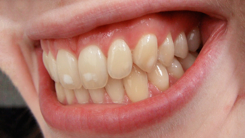 dentes amarelados e facetas capa