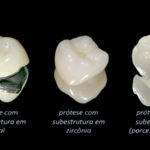 protese-dentaria-em-porcelana-tipo
