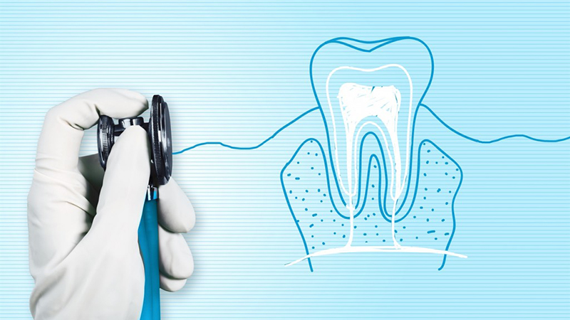 Tratamento de canal para prótese dentária fixa. Informações ao paciente.