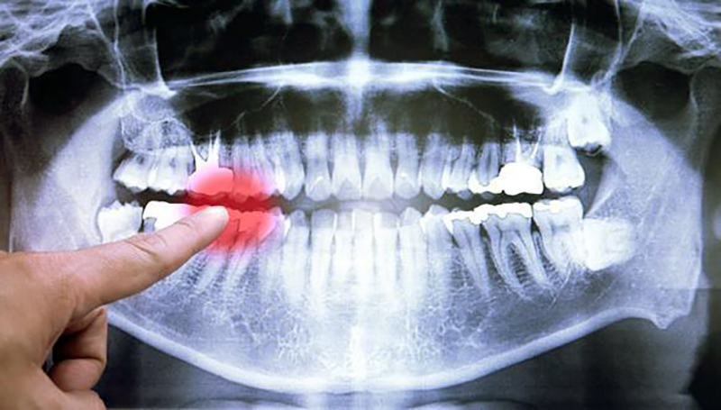 riscos do clareamento dental post blog