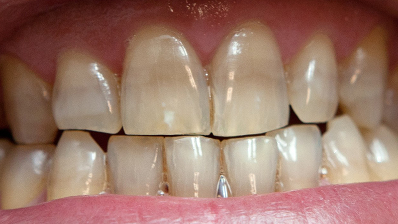 dentes manchados por antibióticos post blog