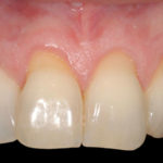 raiz dentária exposta