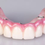 Prótese protocolo: cirurgia guiada traz conforto e segurança ao tratamento. dentadura fixa protocolo implantes