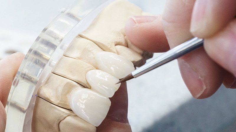 protese dentaria em zircônia com porcelana