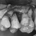 cirurgia gengival cárie dental em raiz