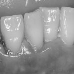 cárie em raiz dental exame