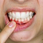 cárie em raiz dentária tratamento