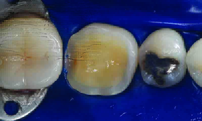 restauração em porcelana dente desgastado