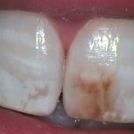 dente manchado por antibiótico microabrasão estética