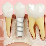 implante dentário cirurgia guiada