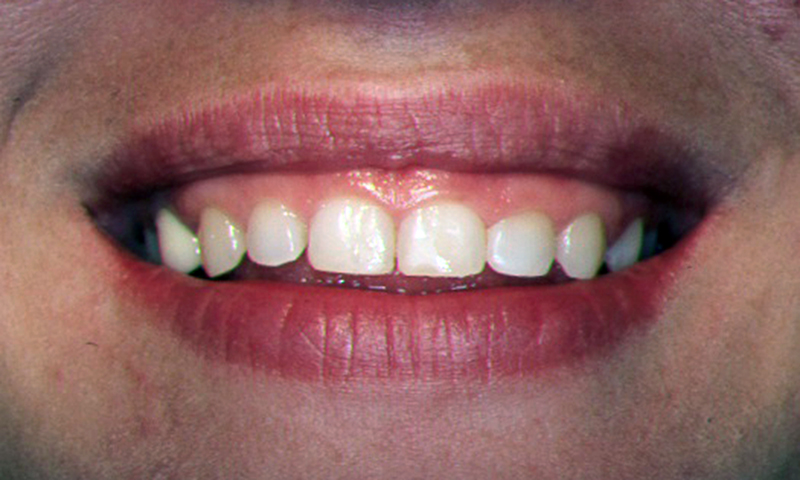 dentes pequenos cirurgia plástica gengival