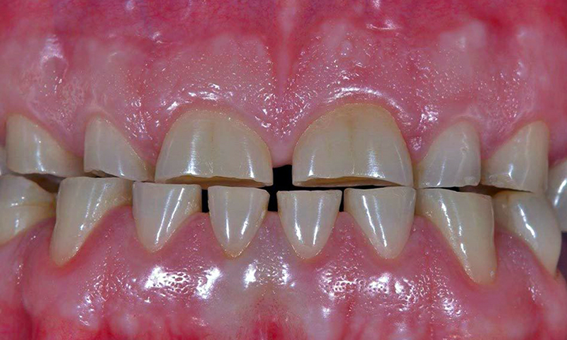desgaste dentário severo