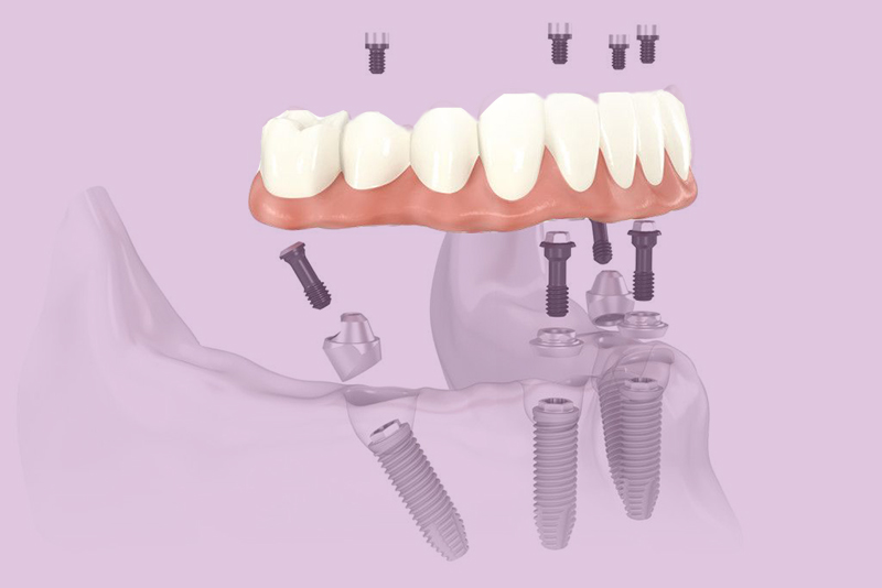 prótese dentária overdenture post blog