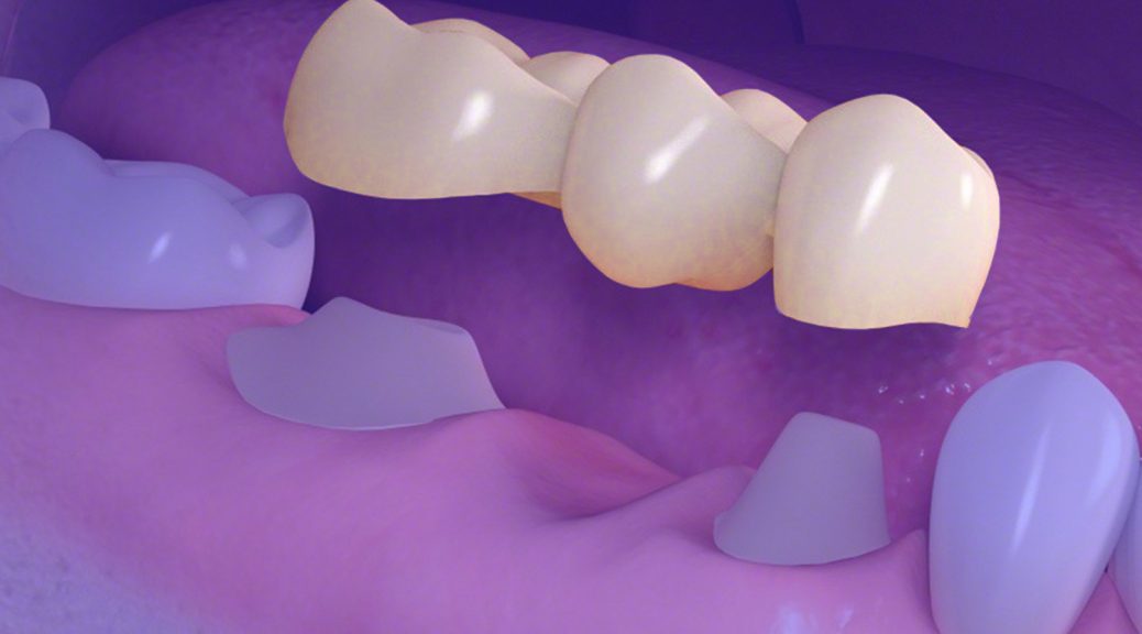 protese dentaria em porcelana substituir implante dentario