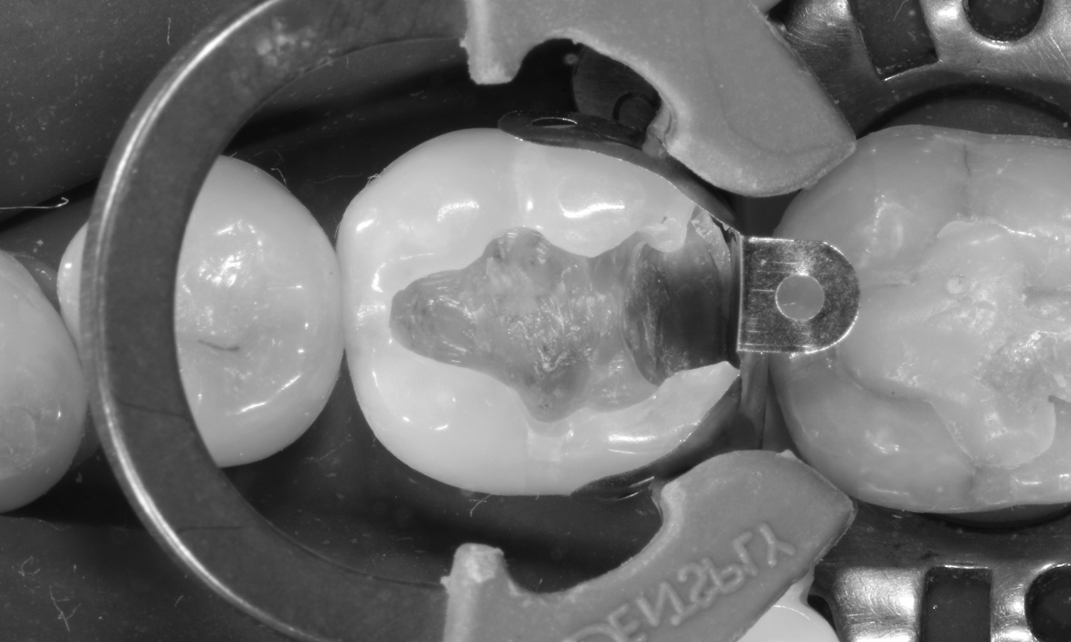 restauração dental em porcelana
