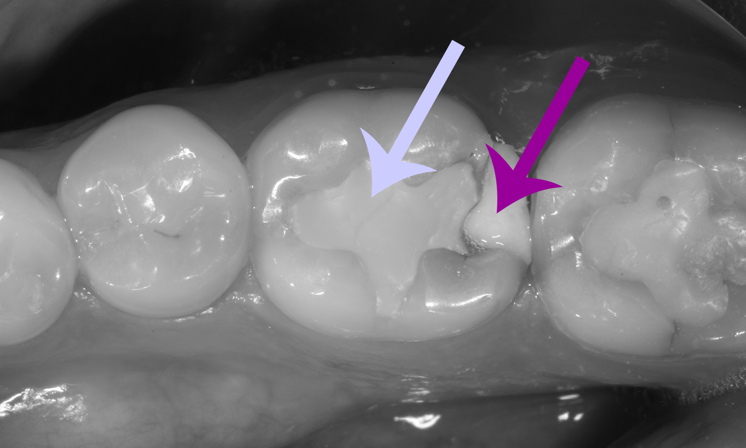 restauração dental em resina material