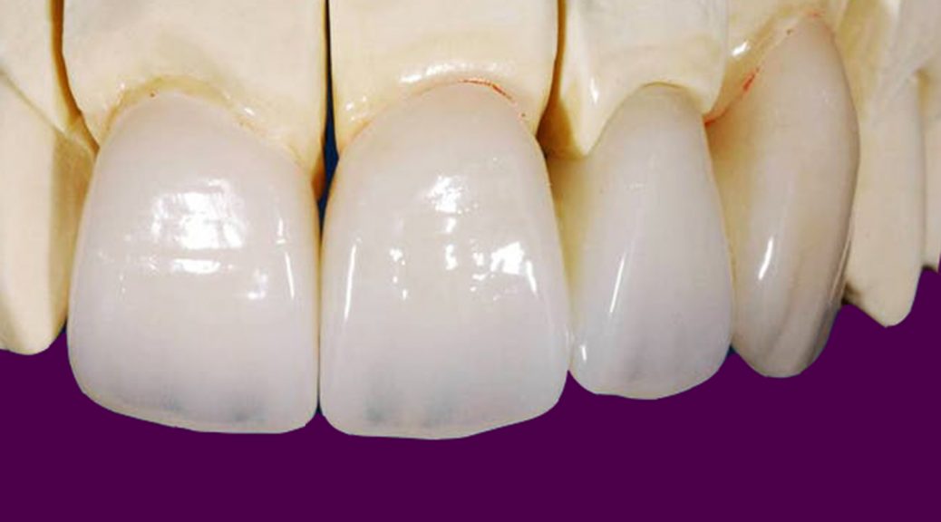 protese dentaria em zirconia indicações pros e contras post blog