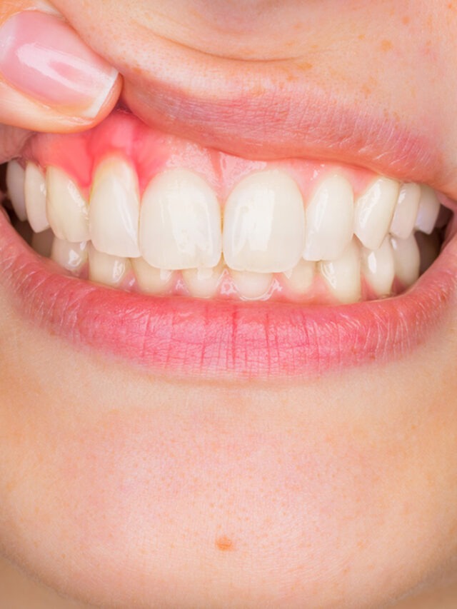 Retração Gengival e Cirurgia com Enxerto de Gengivas.