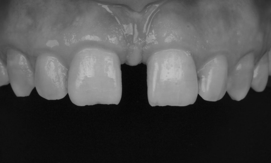 restauração dental em resina diastema