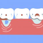 retração gengival prótese dentária post