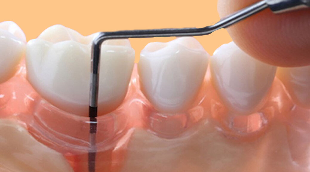 enxerto gengival e periodontite