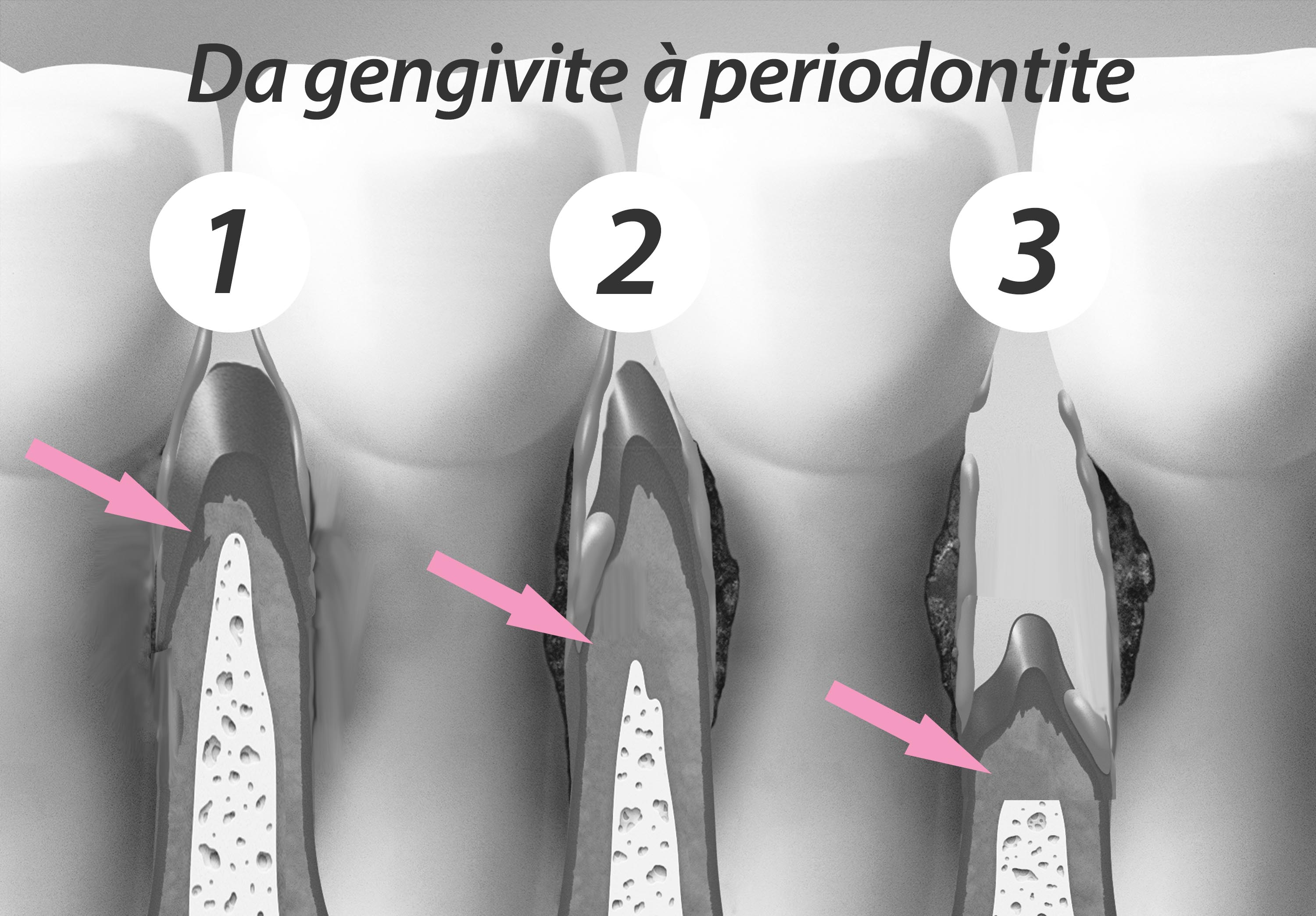 gengivite e periodontite diferença