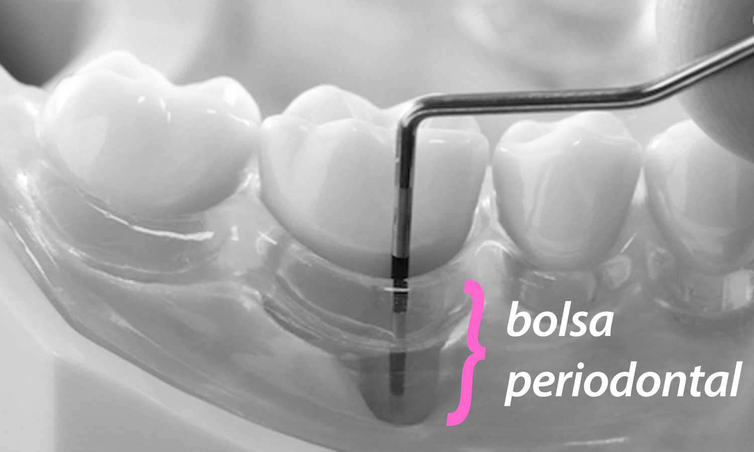 periodontite bolsa periodont al infecção por bactérias