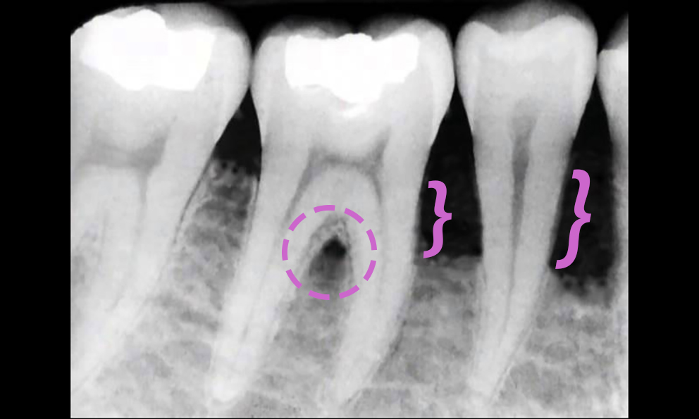 periodontite osso raiz do dente