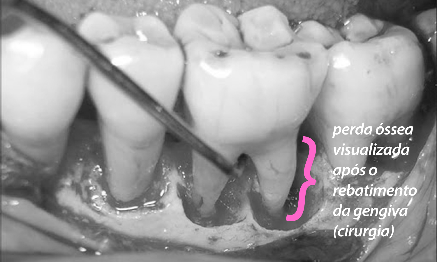 periodontite tratamento cirurgia
