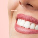 faceta de porcelana riscos aos dentes post blog