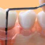 Enxerto de osso é pouco efetivo no tratamento da periodontite.